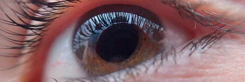 Conoce más sobre el Glaucoma