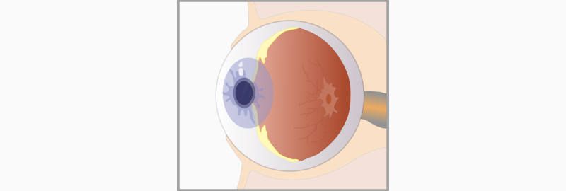 Causas del astigmatismo en Marco Óptico